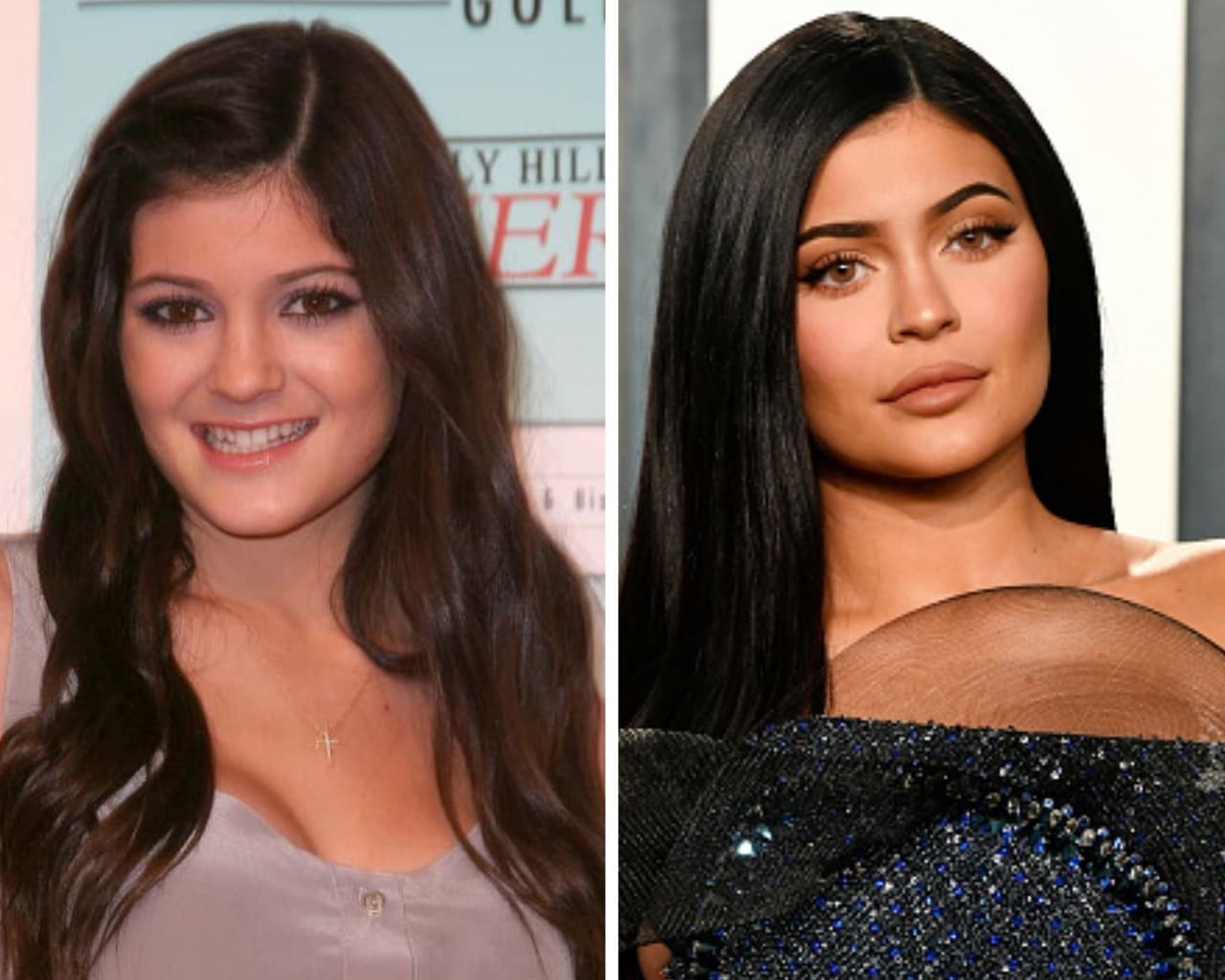 Con el auge de los rellenos estéticos no invasivos, como las inyecciones de ácido hialurónico y 
<i>baby botox</i>, la hermana menor de Kim Kardashian, Kylie Jenner popularizó el uso de fillers en los labios, procedimiento que cambió por completo su rostro y con el que admitió superar el complejo con el que vivió durante la adolescencia, viviendo baja autoestima por tener labios delgados. Levantamiento de ceja y rinoplastia son algunas cirugías que cree que tuvo la hoy mamá de Stormi Webster.