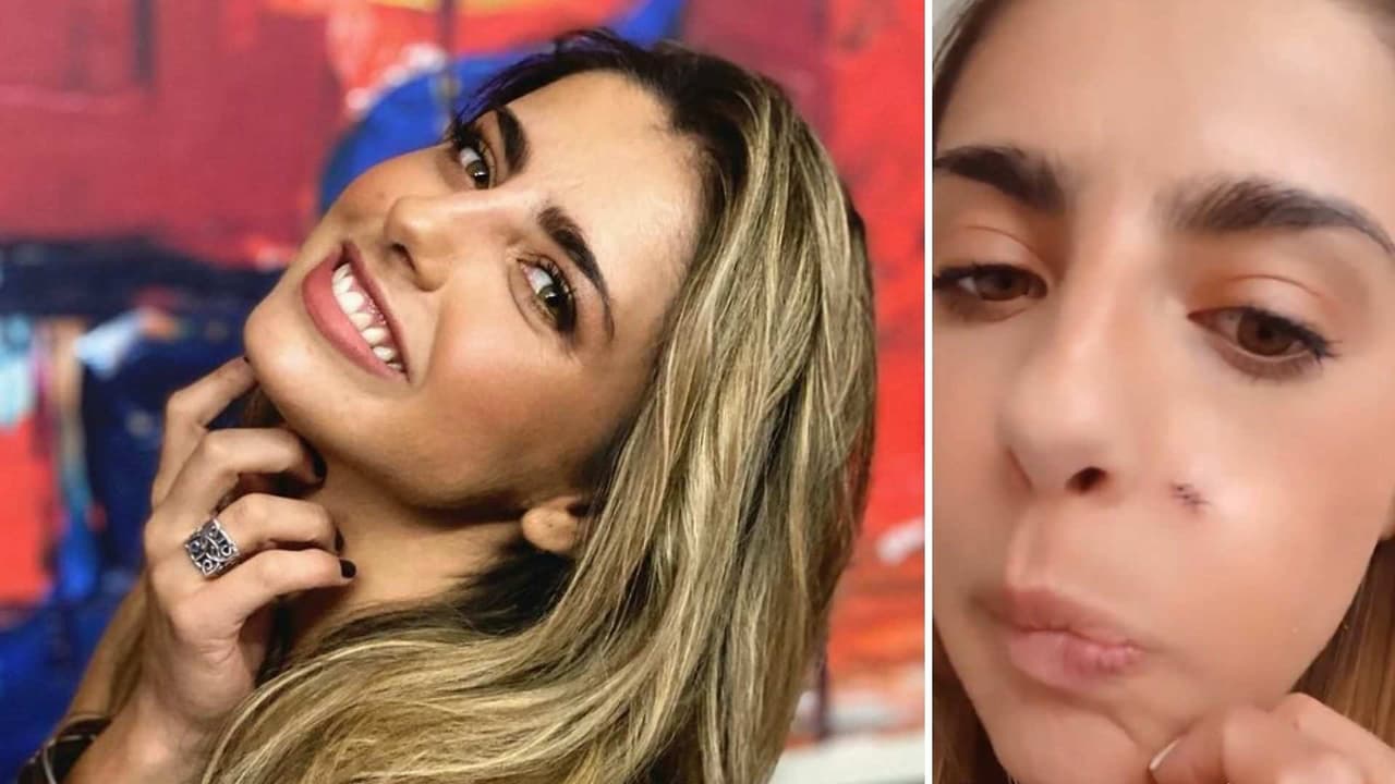 Por clavarse un alfiler, a Michelle Renaud tuvieron que coserle el rostro y muestra cómo le quedó