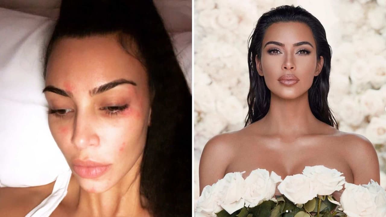 Así oculta Kim Kardashian su psoriasis