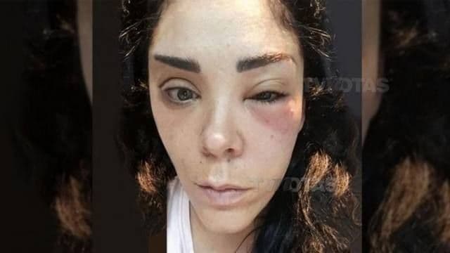 Marichelo Puente estuvo en grave peligro en 2016 al someterse a un tratamiento estético donde le inyectaron su propia sangre en el rostro. La hermana de Anahí contó a una revista que una fuerte infección en la cara la llevó al hospital y que de no llegar a tiempo pudo haber sufrido un paro cardiorrespiratorio o un derrame cerebral.