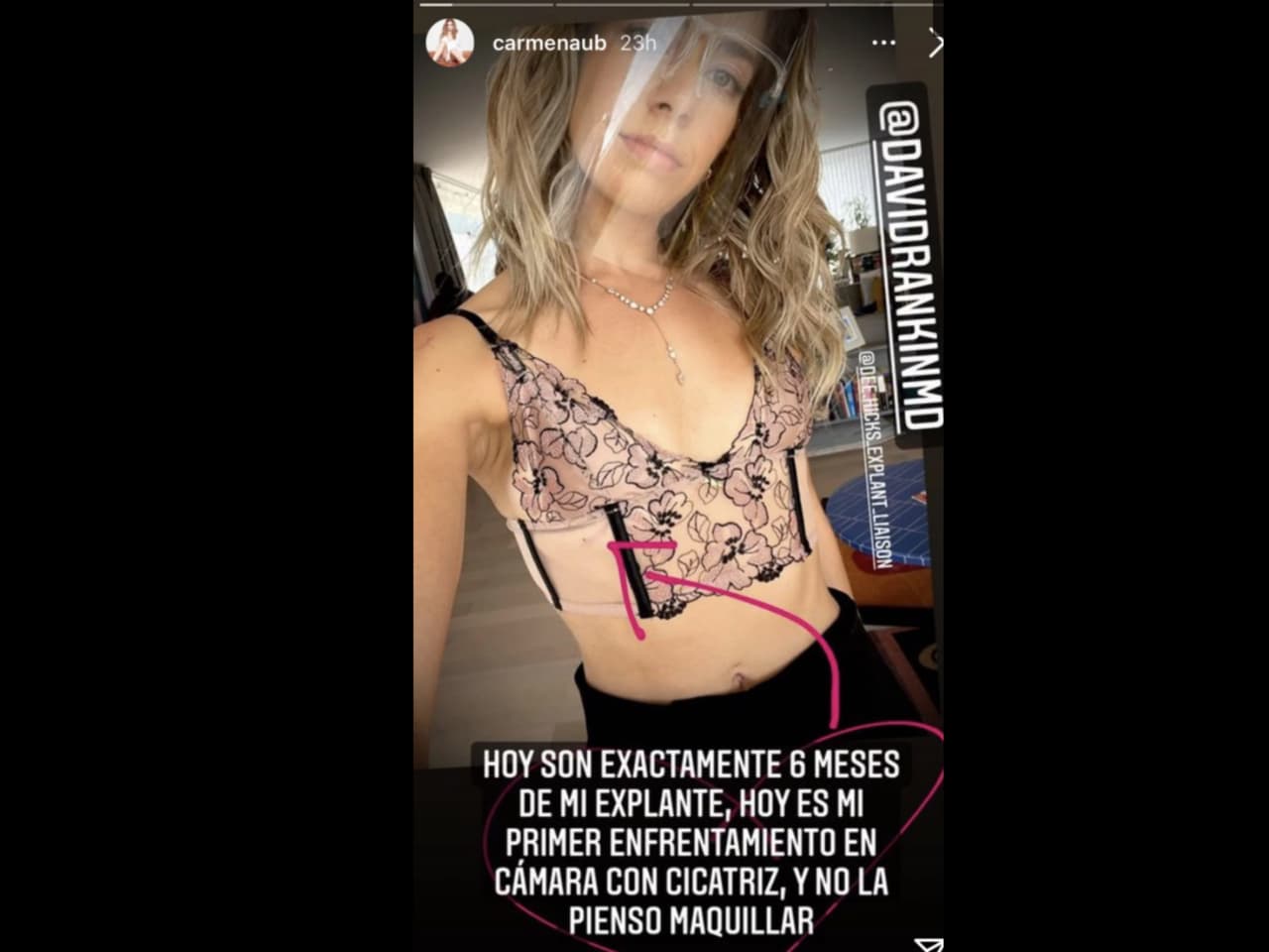 Carmen Aub muestra la cicatriz que le dejó su cirugía para retirar sus implantes de seno