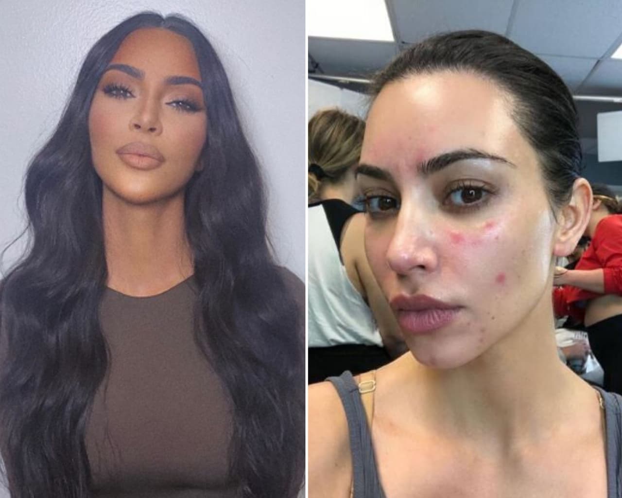 En febrero del 2018, Kim Kardashian compartió a sus seguidores la luche que tiene con la psioriases, una enfermedad en la que las células de la piel se acumulan y forman escamas y enrojecimiento. La socialité ha hablado de lo difícil que resulta para su maquillista, Mario Dedivanovic's, el disimular su condición cutánea. 
<br>
<br>"Tengo psoriasis por toda mi cara, así que ha sido todo un desafío. Nosotros nunca habíamos tenido esto antes".
<br>