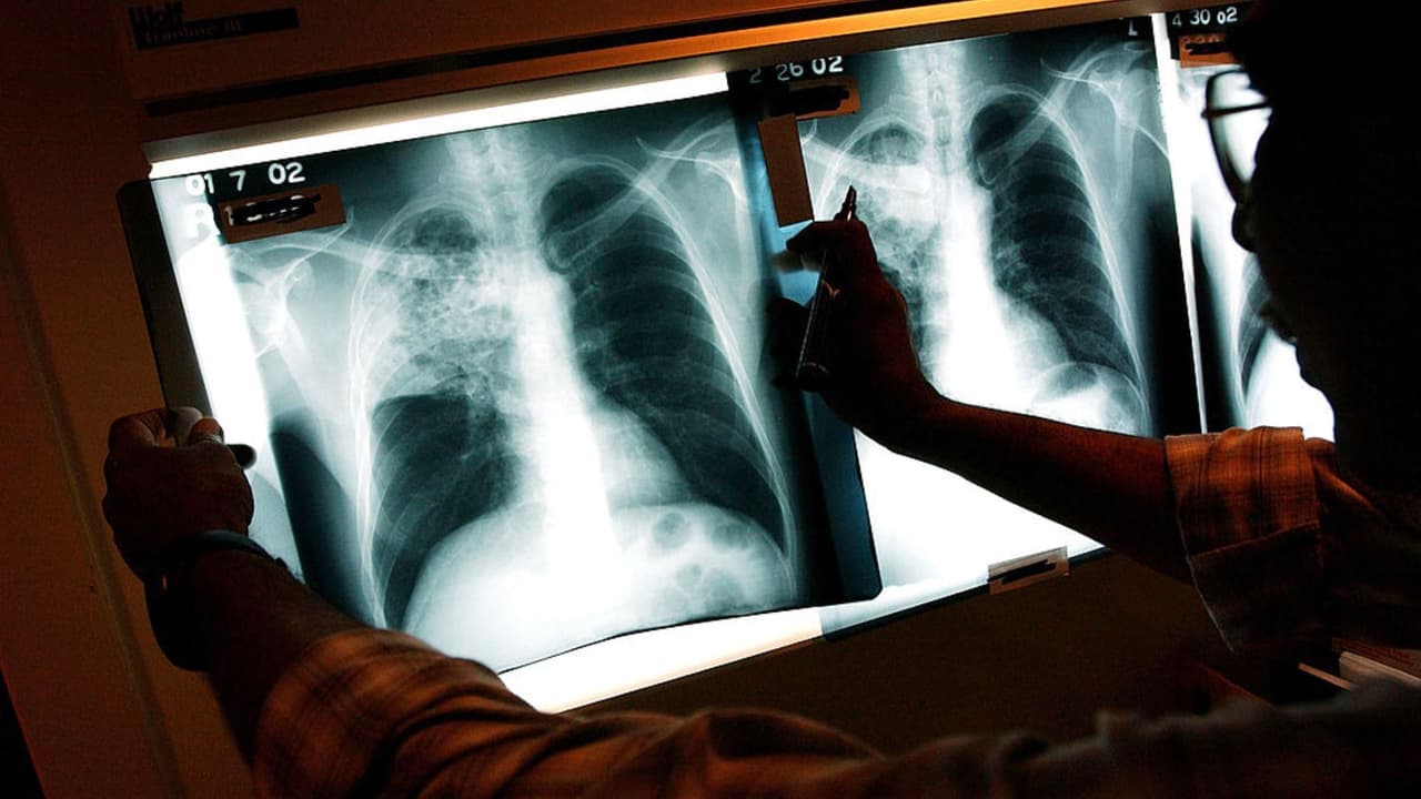 Reportan dos casos de tuberculosis en una preparatoria del distrito escolar de Klein