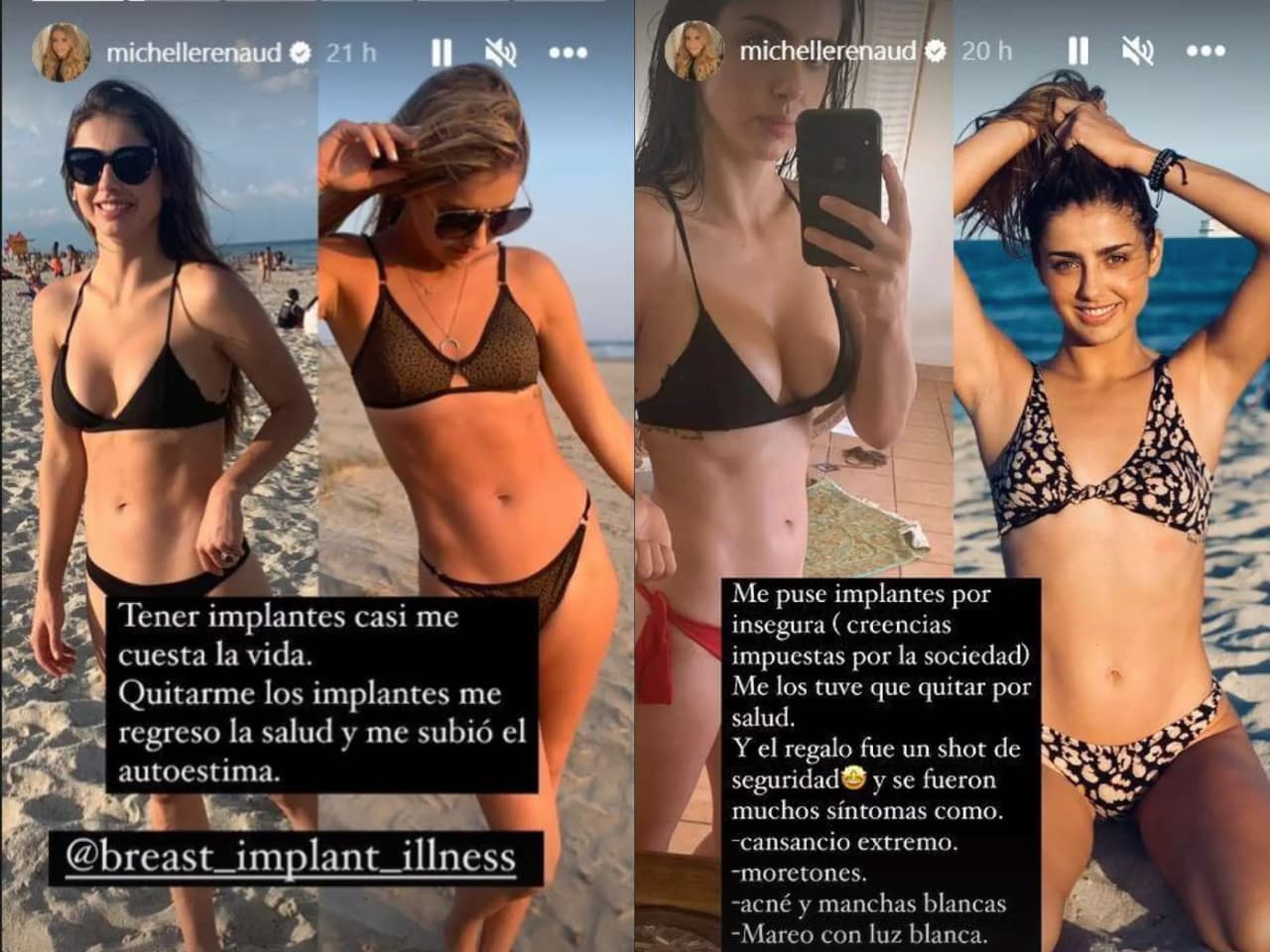 Michelle Renaud recordó su mala experiencia con prótesis mamarias.