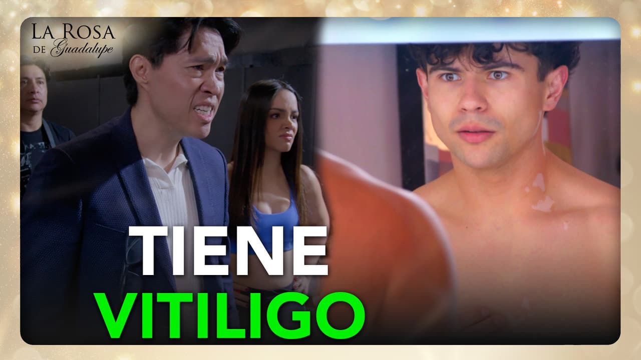 Joaquín tiene vitiligo y lo desprecian en la agencia de modelos por no ser perfecto