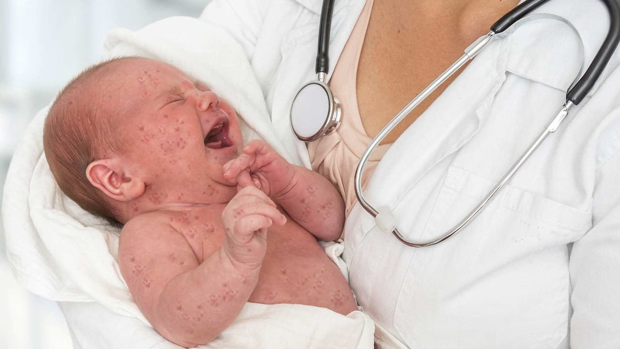 El regreso del Sarampión: la amenaza de los antivacunas