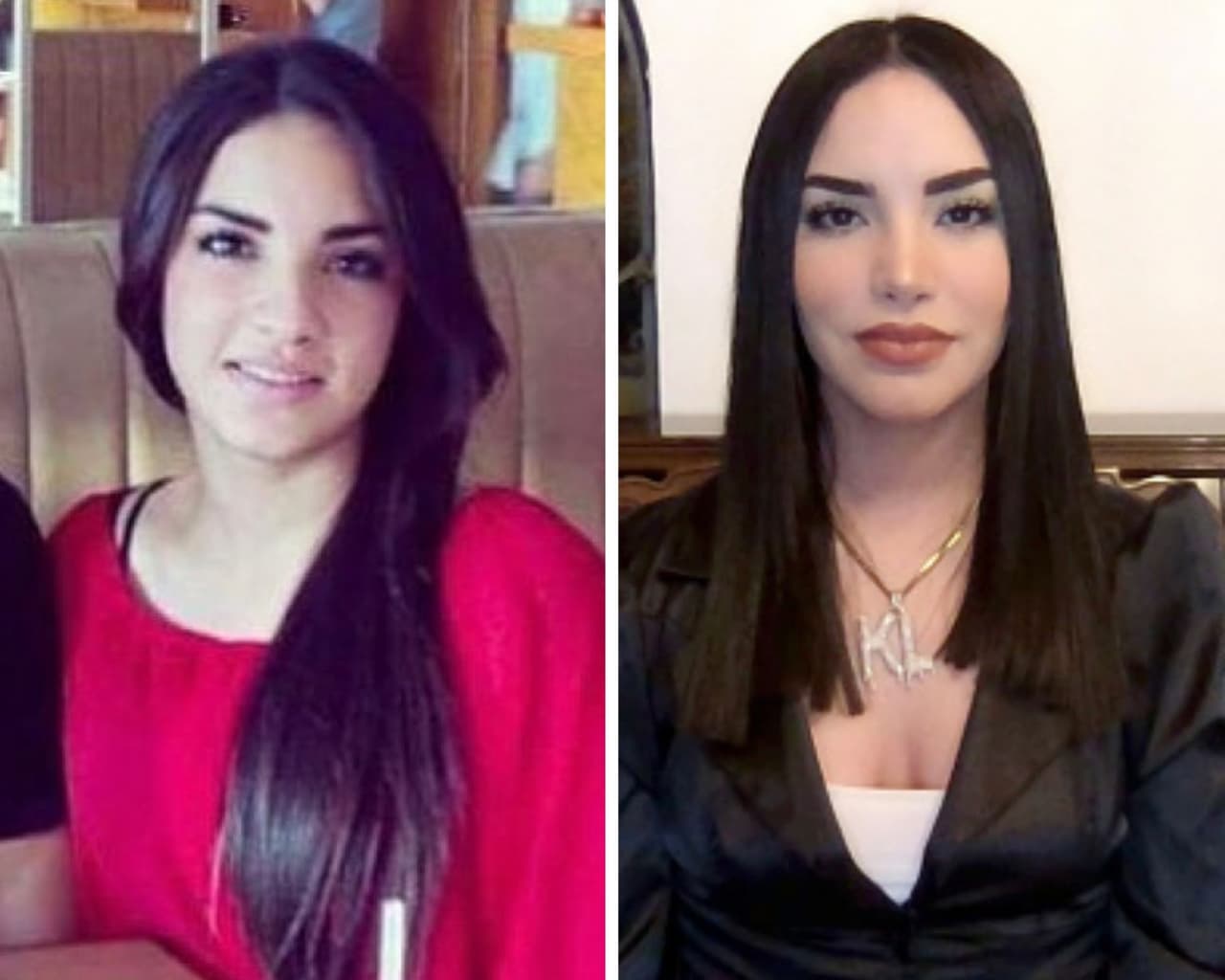 Antes de convertirse en una de las celebridades de Internet más famosas en Youtube México, Kimberly Loaiza era un chica de 20 años sin una sola visita al cirujano plástico. En septiembre del 2020, la esposa de Juan de Dios Pantoja reveló las intervenciones estéticas a las que llegó a someterse hace un par de años, las cuales fueron rinoplastía, la cual cambio su perfil y con la que ahora luce una nariz mucho más diminuta y respingada. También redujo grasa en sus mejillas, papada y se sometió liposucción de brazos.