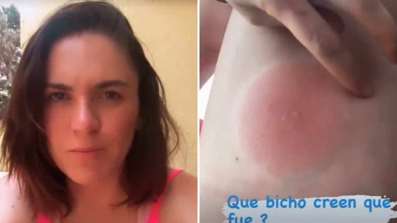 Zoraida Gómez sufre picadura de bichito y le deja enorme ronchota