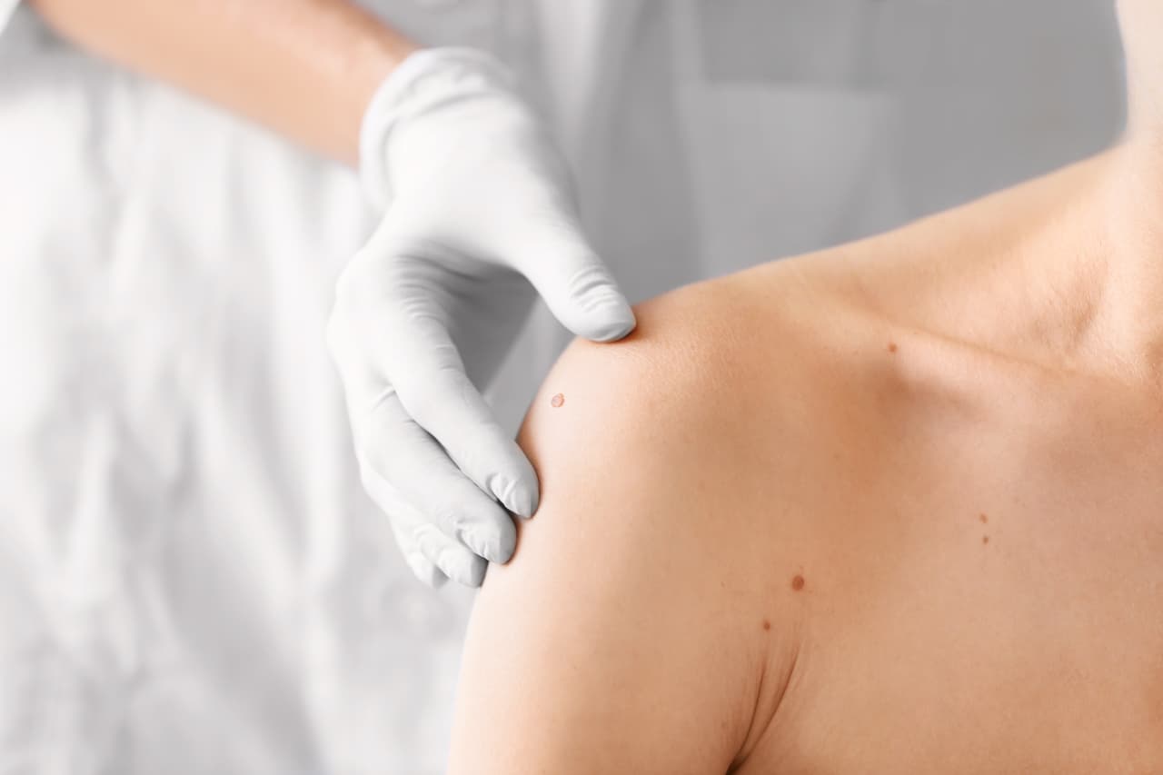 "También es bueno revisar tu piel varias veces al año con un espejo en casa, e ir con el dermatólogo al menos una vez al año para revisar de cáncer de piel. Entre más pronto se pueda diagnosticar el pronóstico es mejor, por eso es importante una vez al año revisar todos tus lunares con el dermatólogo".