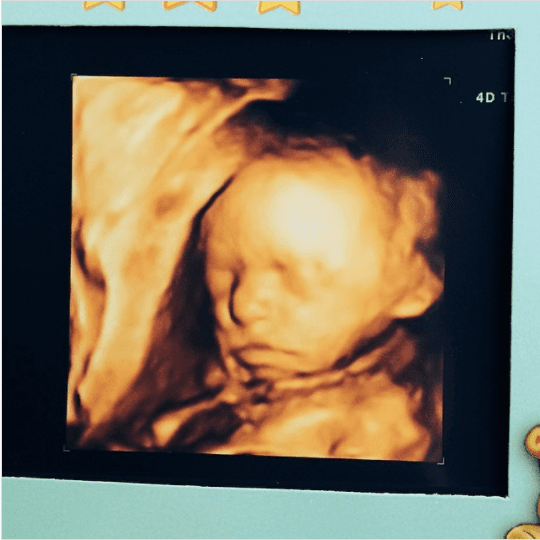 Ahora es toda una princesa, pero parece que fue ayer que Jacky Bracamontes anunciaba que Caro venía en camino. En abril del 2014, Jacky expuso con gran felicidad su segundo embarazo. Con el breve mensaje de “Hola a todos!!! Soy #Carolina”, dio a conocer la llegada de su segunda hija al lado de Martín Fuentes. Desde entonces se supo que Caro nacería los primeros días de julio. Y así fue, el 9 de julio del 2014 nació la princesa de papá.